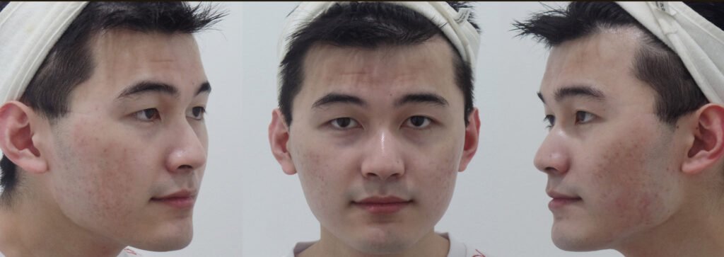 个别患者的治疗前后对比照片