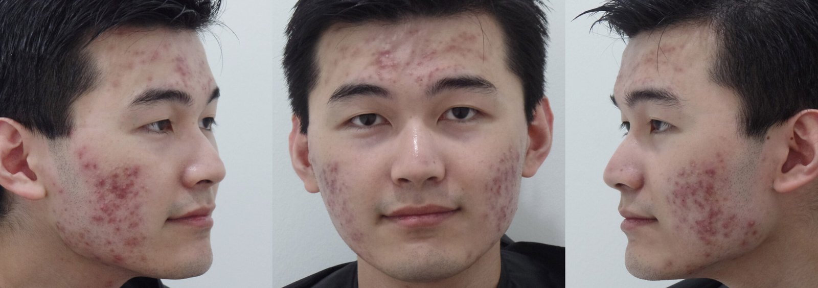 acne Bevis Goh Jian Rui before 3side blog