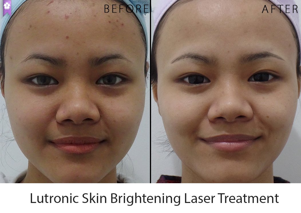 before after front
