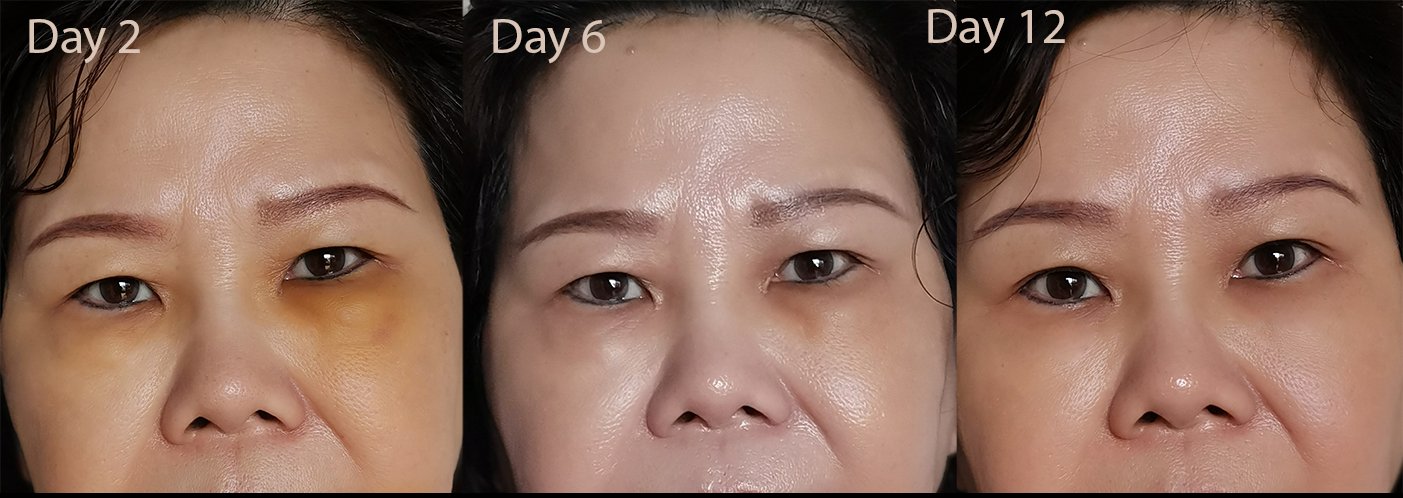daily for eye bag blog