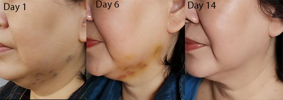 daily for jawline blog