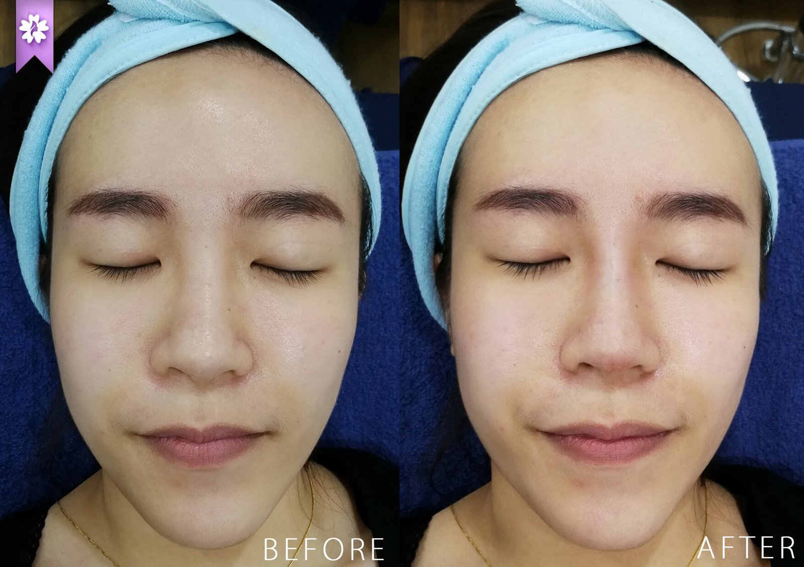 Nose Thread Lift Beau &amp; Hans