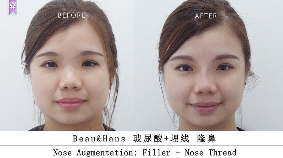 nose augmentation beau&amp;hans