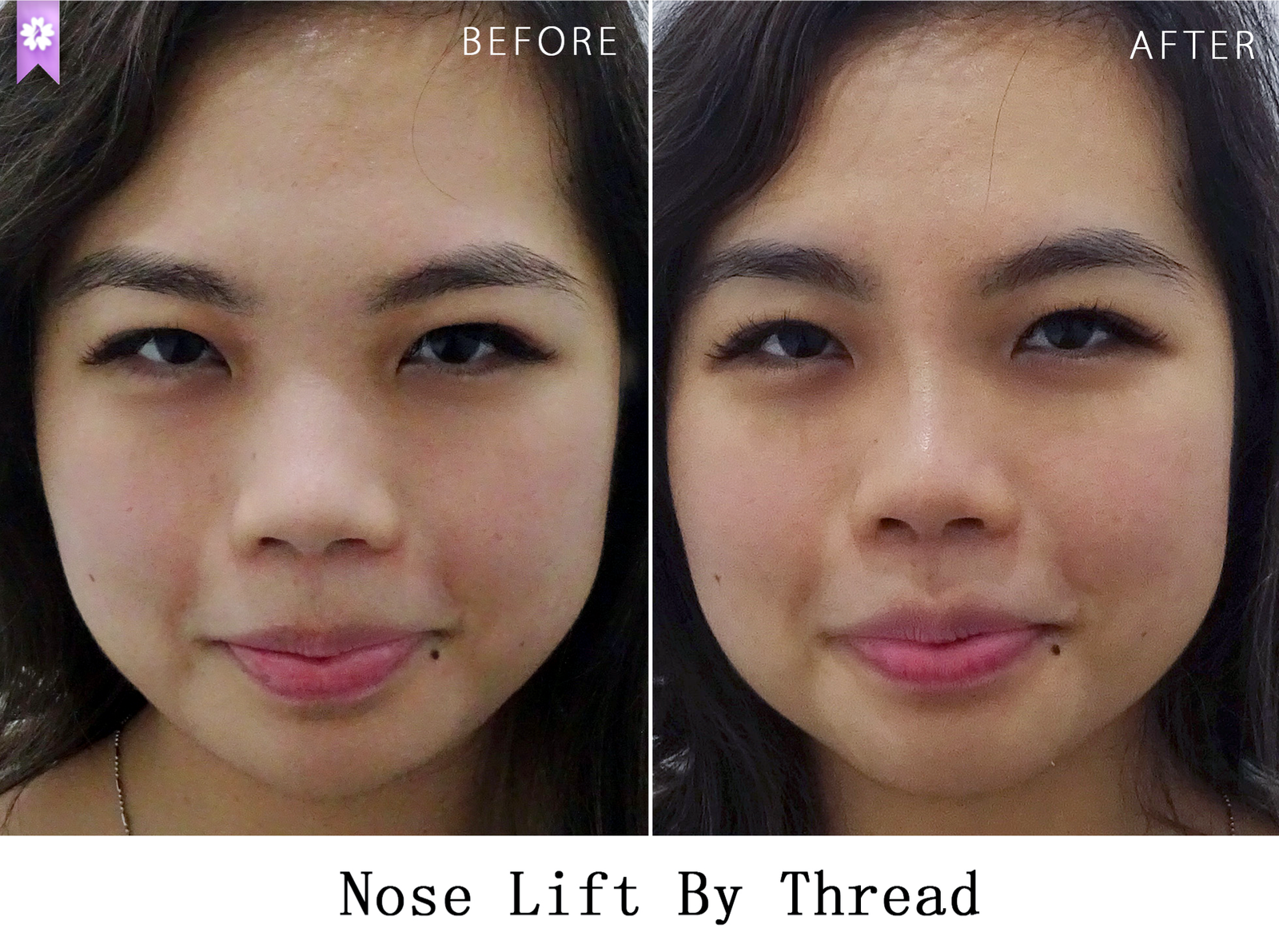 nose augmentation by thread b4 after