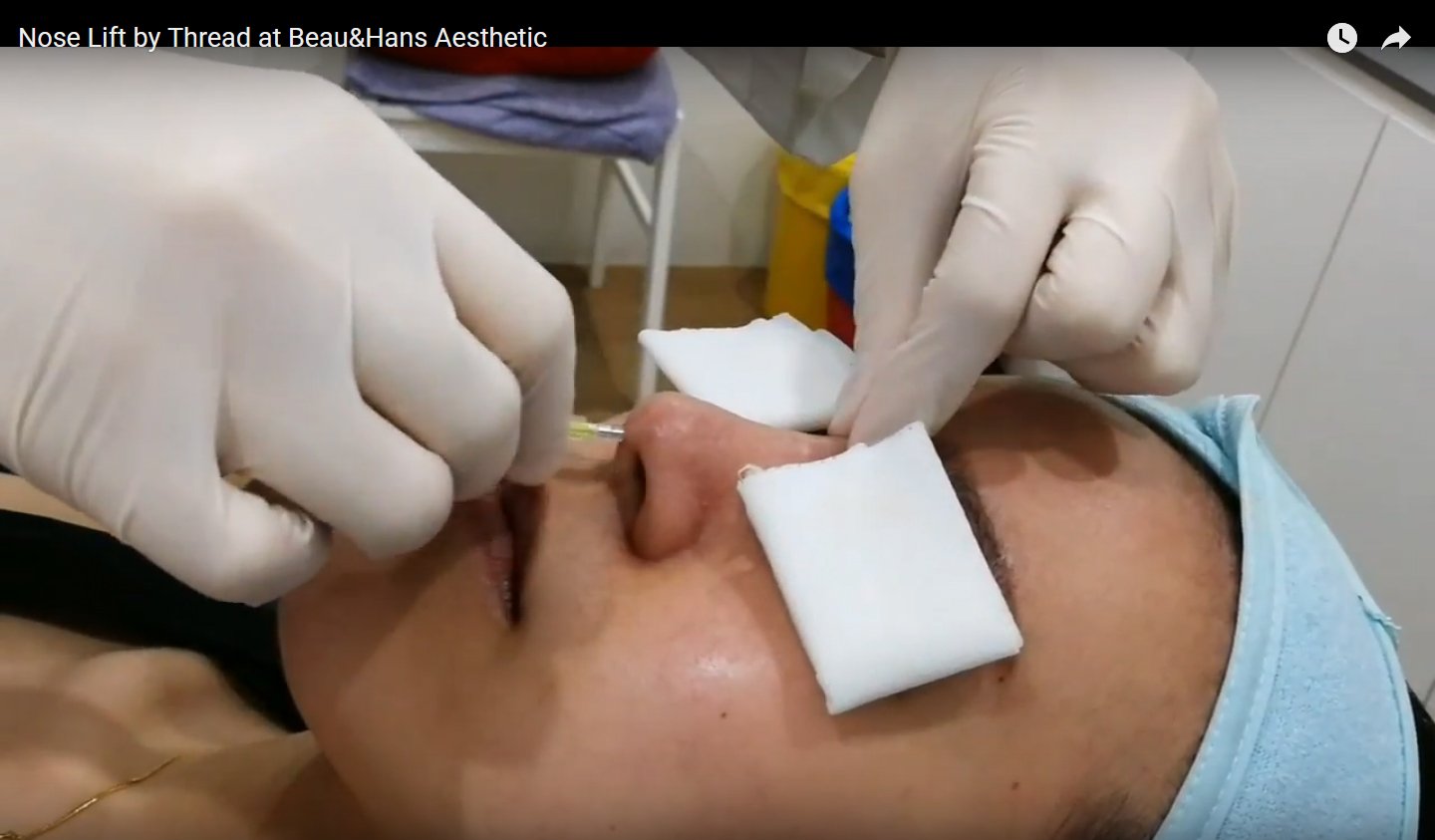 Nose thread video
