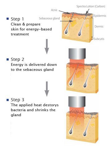 spectra peel