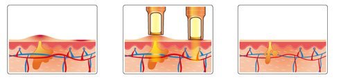 spectra peel 2