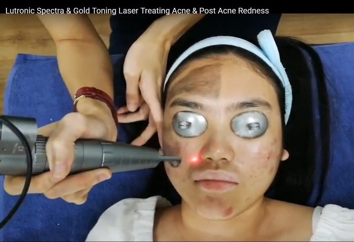 Lutronic laser for acne & redness